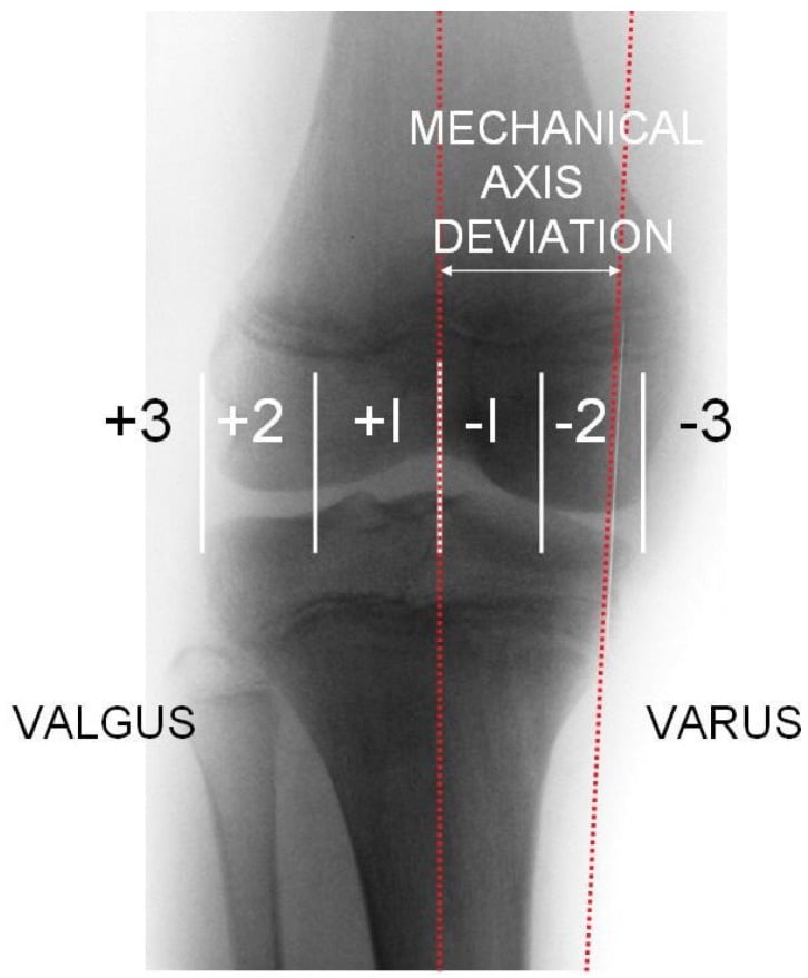 Frontal radiograph of the knee region with two red dotted lines and the mechanical axis deviation marked as the distance between them, the tibial plateau divided into zones numbered +1 to +3 towards the side labelled VALGUS and -1 to -3 towards the side labelled VARUS.