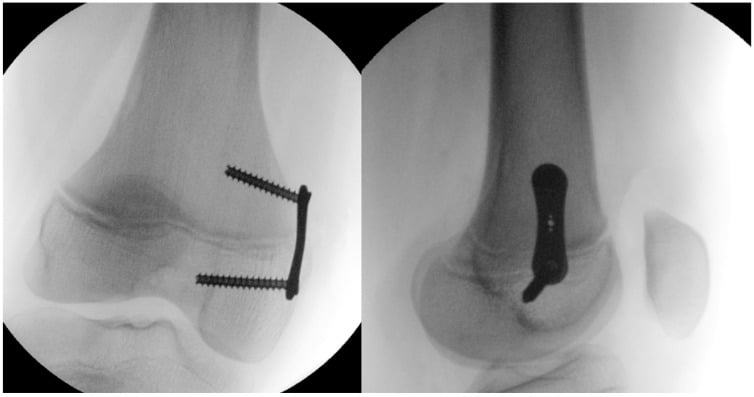 Two intra-operative fluoroscopy stills of a distal femur: on the left a frontal view with a two-hole tension-band plate bridging the physis, one screw above and one below it; on the right a lateral view of the same plate.