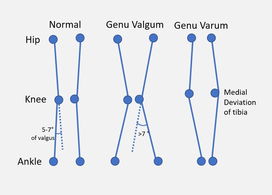 Schematic of normal coronal alignment, genu valgum and genu varum with hip, knee and ankle landmarks