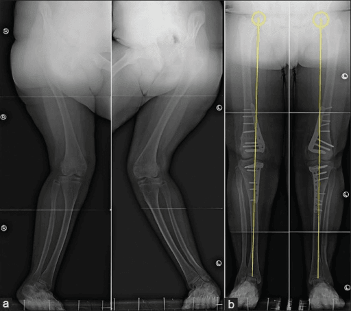 Long-leg radiographs showing mechanical axis correction