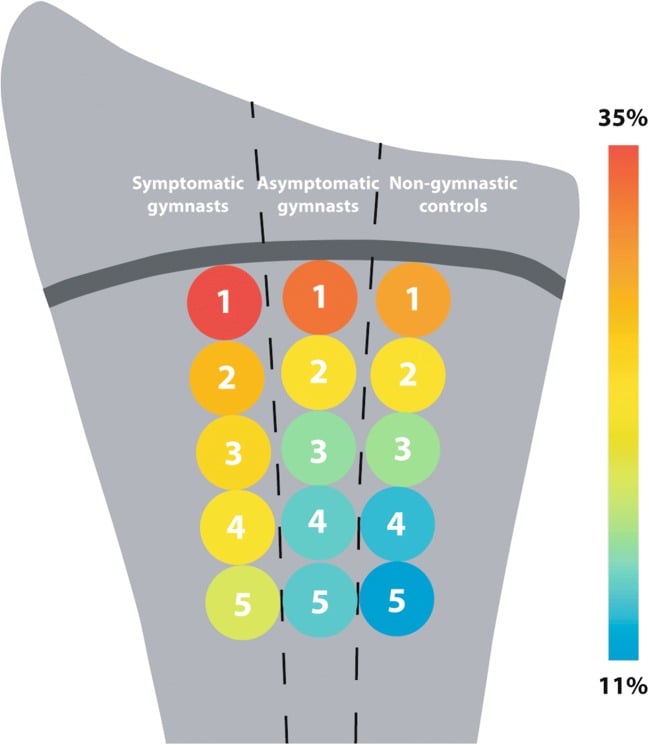 Regional MRI water-signal map comparing symptomatic and asymptomatic gymnasts with controls