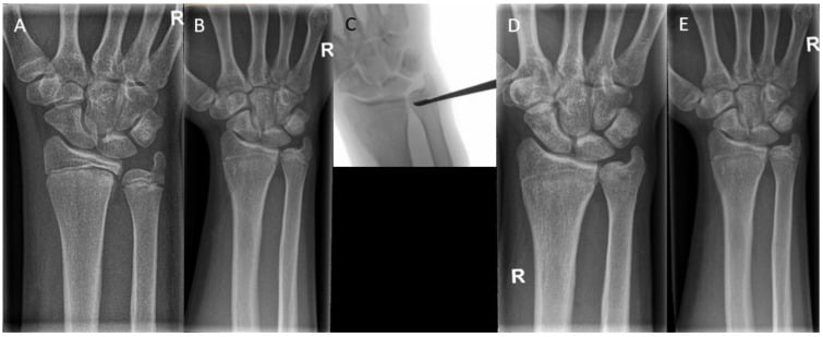 Serial wrist radiographs showing distal radial physeal arrest progression to ulna plus and ulnar epiphysiodesis
