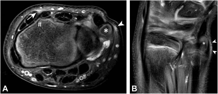Axial and coronal MRI showing dorsal and ulnar wrist impingement changes in a gymnast