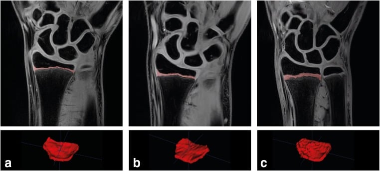 Three-column comparison of wrist MRI slices and 3D reconstructions of the distal radial physis in a non-gymnast, asymptomatic gymnast, and symptomatic gymnast showing progressive physis widening