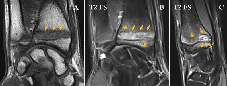 Three-panel MRI of a gymnast's wrist showing coronal T1-weighted, coronal T2 fat-suppressed, and sagittal T2 fat-suppressed images with arrows marking the widened distal radial physis and asterisks indicating bone marrow edema