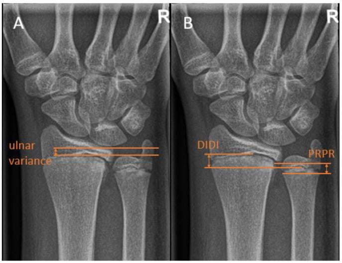 Paediatric wrist radiographs demonstrating two methods of measuring ulnar variance