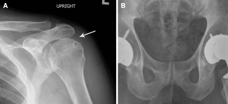 Two-panel radiograph: AP shoulder with humeral head chondrocalcinosis and an AP pelvis