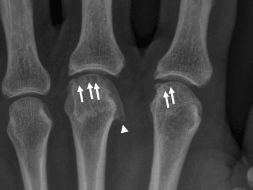 Hand radiograph showing osteophytes and subchondral cysts at the 2nd and 3rd MCP joints with a hook osteophyte on the 3rd metacarpal head