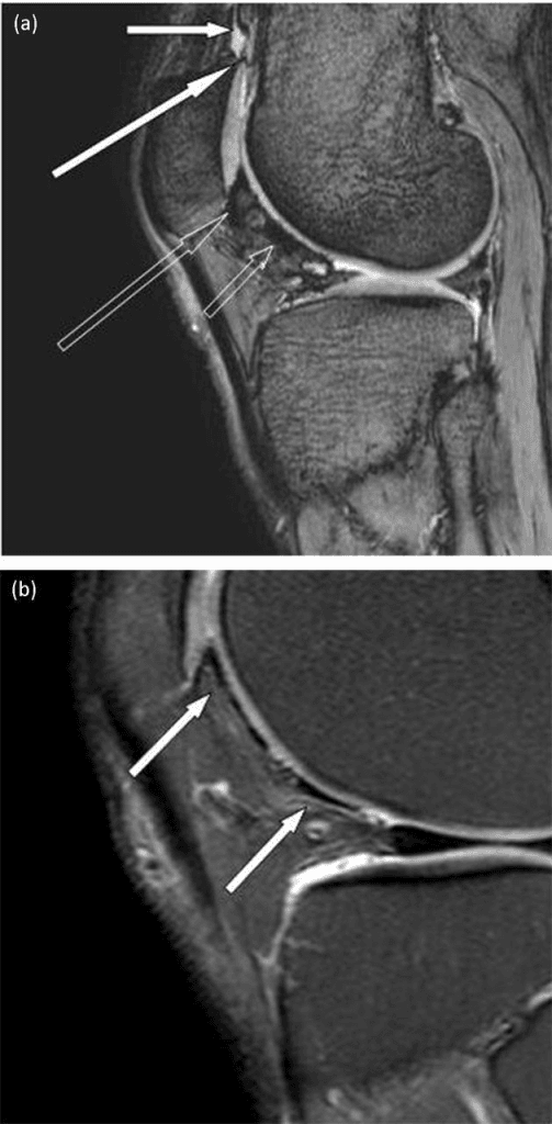 Two-panel T2-star weighted knee MRI showing focal low-signal iron deposits in the synovium