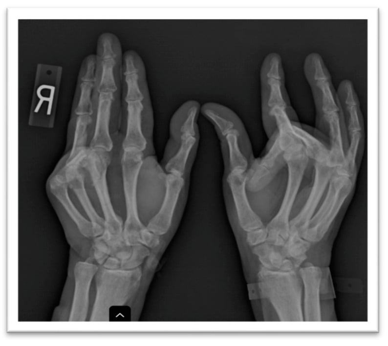 Bilateral hand radiograph showing severe interphalangeal bony proliferation, fixed flexion and multiple subluxations in a patient with hereditary haemochromatosis