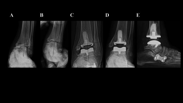 Serial ankle radiographs showing varus talar tilt, correction on valgus stress, total ankle arthroplasty and one-year weight-bearing alignment