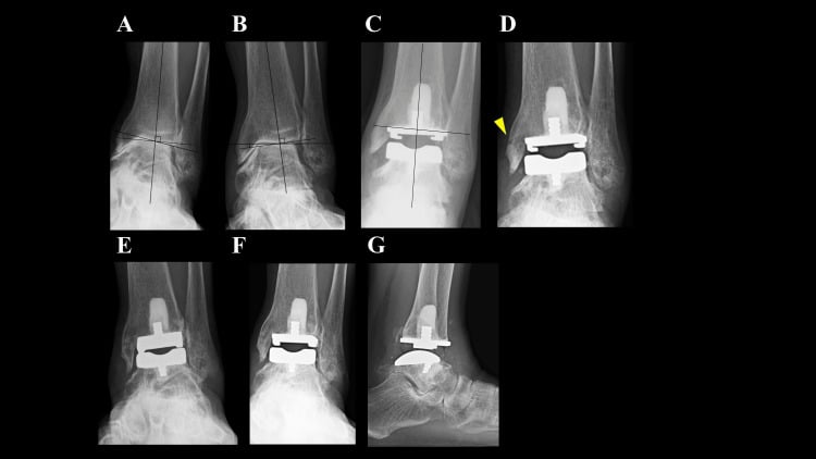 Serial ankle radiographs showing total ankle arthroplasty followed by a nondisplaced medial malleolar fracture that united without displacement