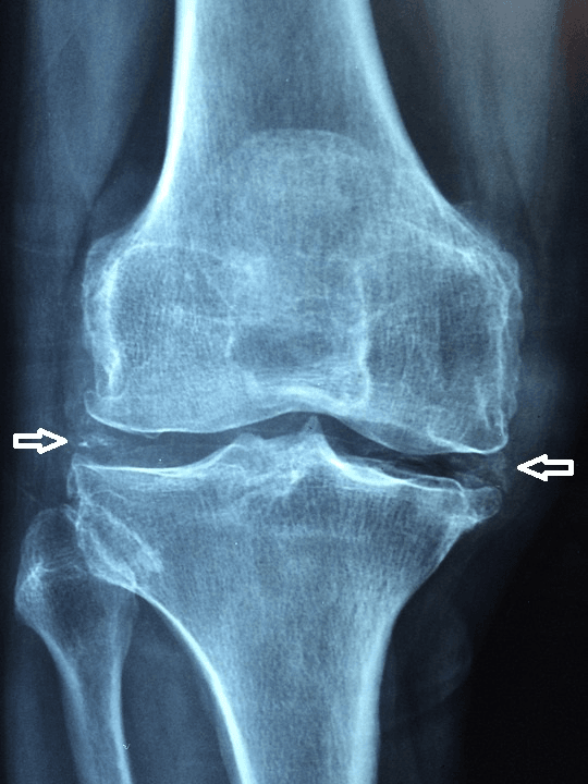Knee radiograph showing chondrocalcinosis of the menisci and articular cartilage
