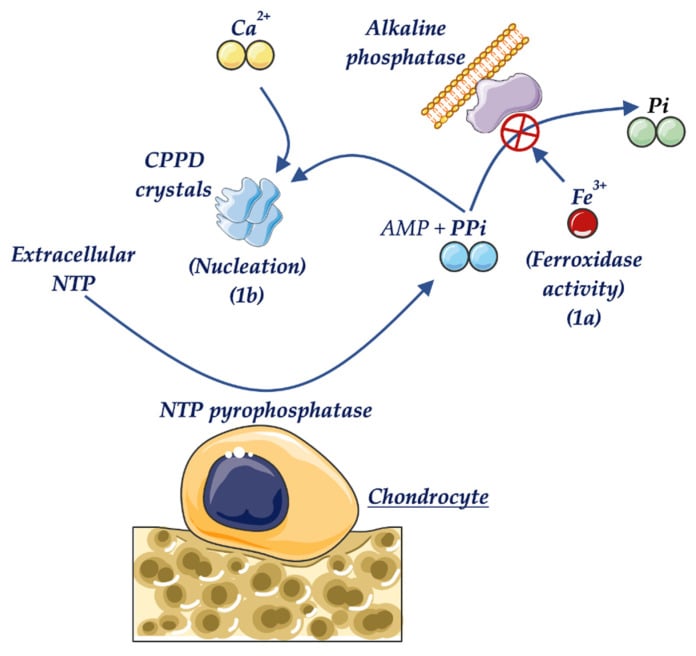 Diagram showing iron inhibition of alkaline phosphatase increasing extracellular pyrophosphate and calcium pyrophosphate crystal nucleation