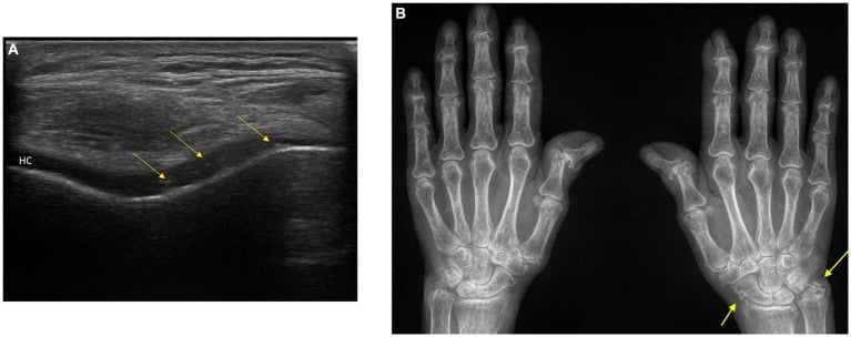 Knee ultrasound showing hyperechoic CPP deposits within hyaline cartilage beside hand radiographs showing wrist chondrocalcinosis