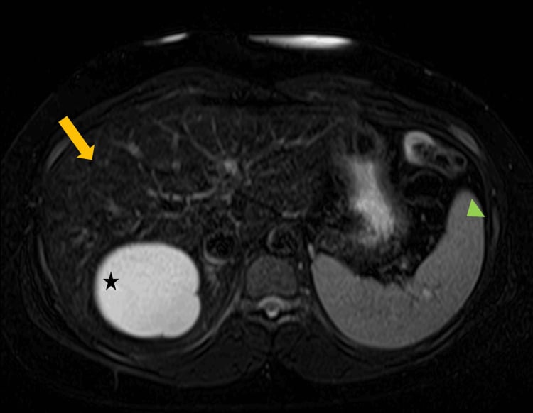 Axial T2-weighted gradient-echo MRI showing a dark iron-loaded liver compared with a bright spleen