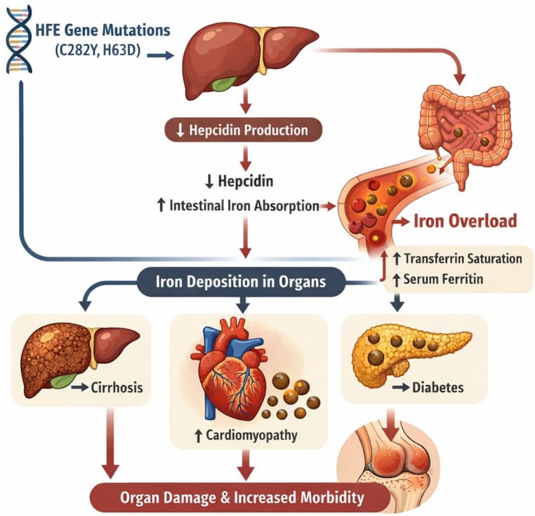 Schematic showing HFE variants reducing hepcidin, increasing intestinal iron absorption and causing iron deposition in liver, heart, pancreas and joints
