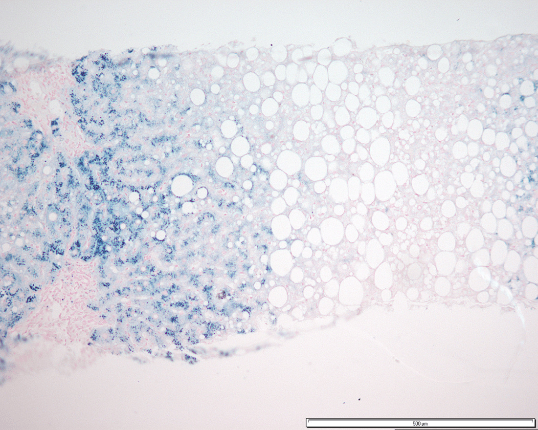 Liver biopsy with Prussian blue (Perls) stain showing heavy iron deposition