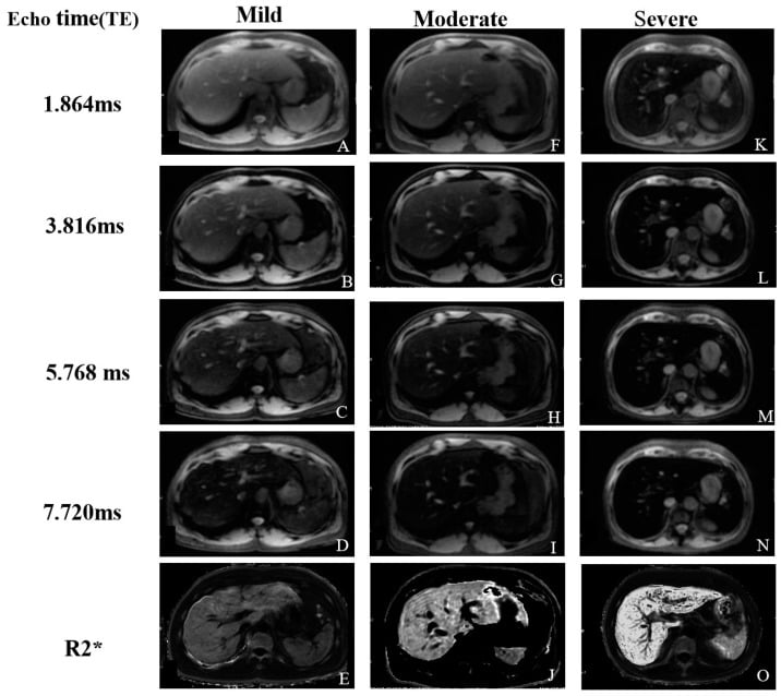 Serial gradient-echo liver MRI and R2-star maps demonstrating mild, moderate and severe iron overload across increasing echo times