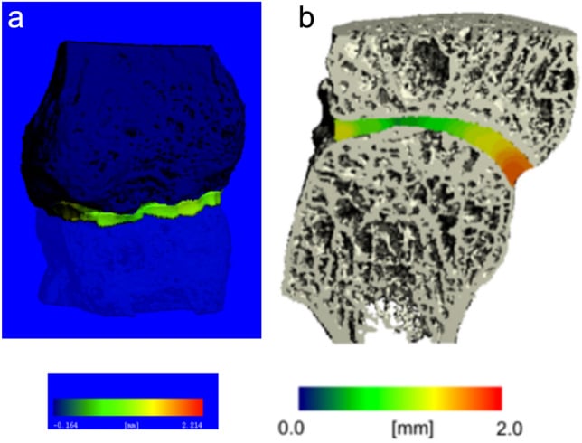 Three-dimensional MCP joint-space maps in haemochromatosis with blue and green indicating narrow irregular joint space