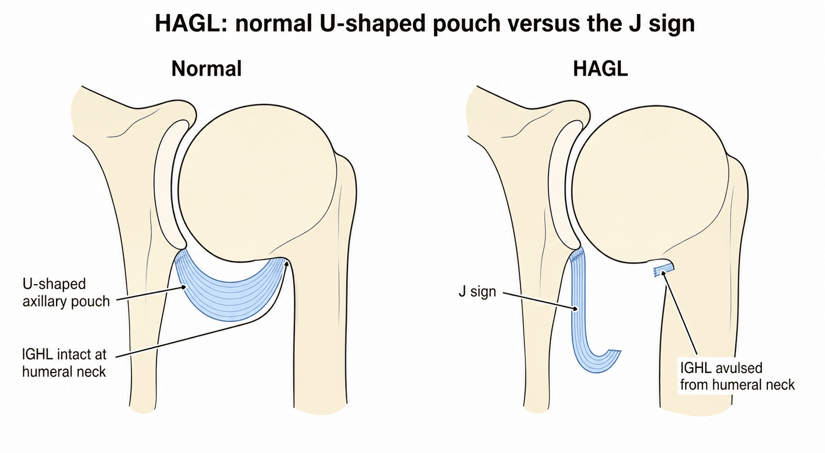 Two-panel schematic of a coronal shoulder section contrasting the normal U-shaped axillary pouch with the HAGL J-sign, where the IGHL is avulsed from the humeral neck and the pouch droops into a J.