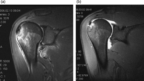 Oblique coronal shoulder MR images showing an anterior HAGL lesion after traumatic anterior dislocation and complete recovery at 24 days.