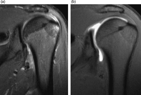 Oblique coronal shoulder MR images showing a posterior HAGL lesion after traumatic anterior dislocation and complete recovery at 31 days.