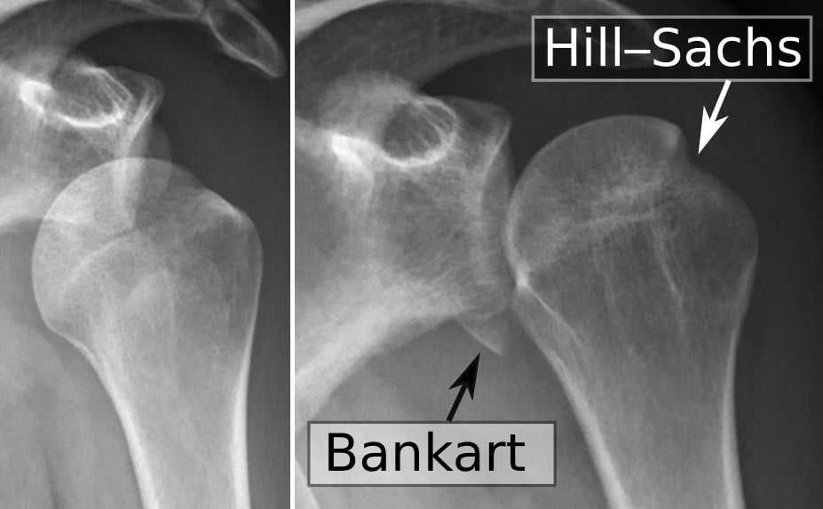 Two-panel AP shoulder radiograph; right panel labels a bony Bankart at the antero-inferior glenoid and a Hill-Sachs impaction on the humeral head.