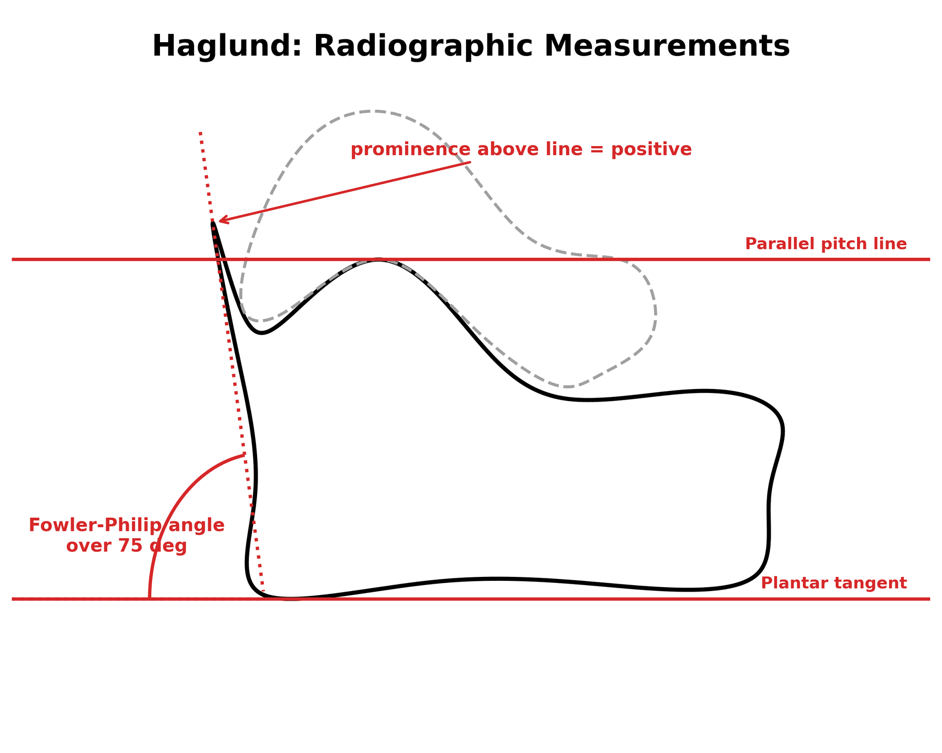 Schematic of the lateral calcaneus showing the parallel pitch lines and the Fowler-Philip angle used to quantify a Haglund prominence