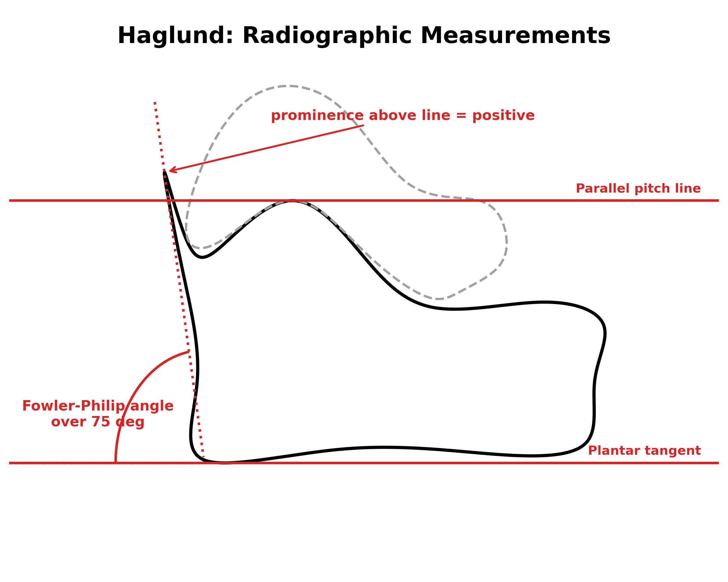 Schematic of the lateral calcaneus showing the parallel pitch lines and the Fowler-Philip angle used to quantify a Haglund prominence