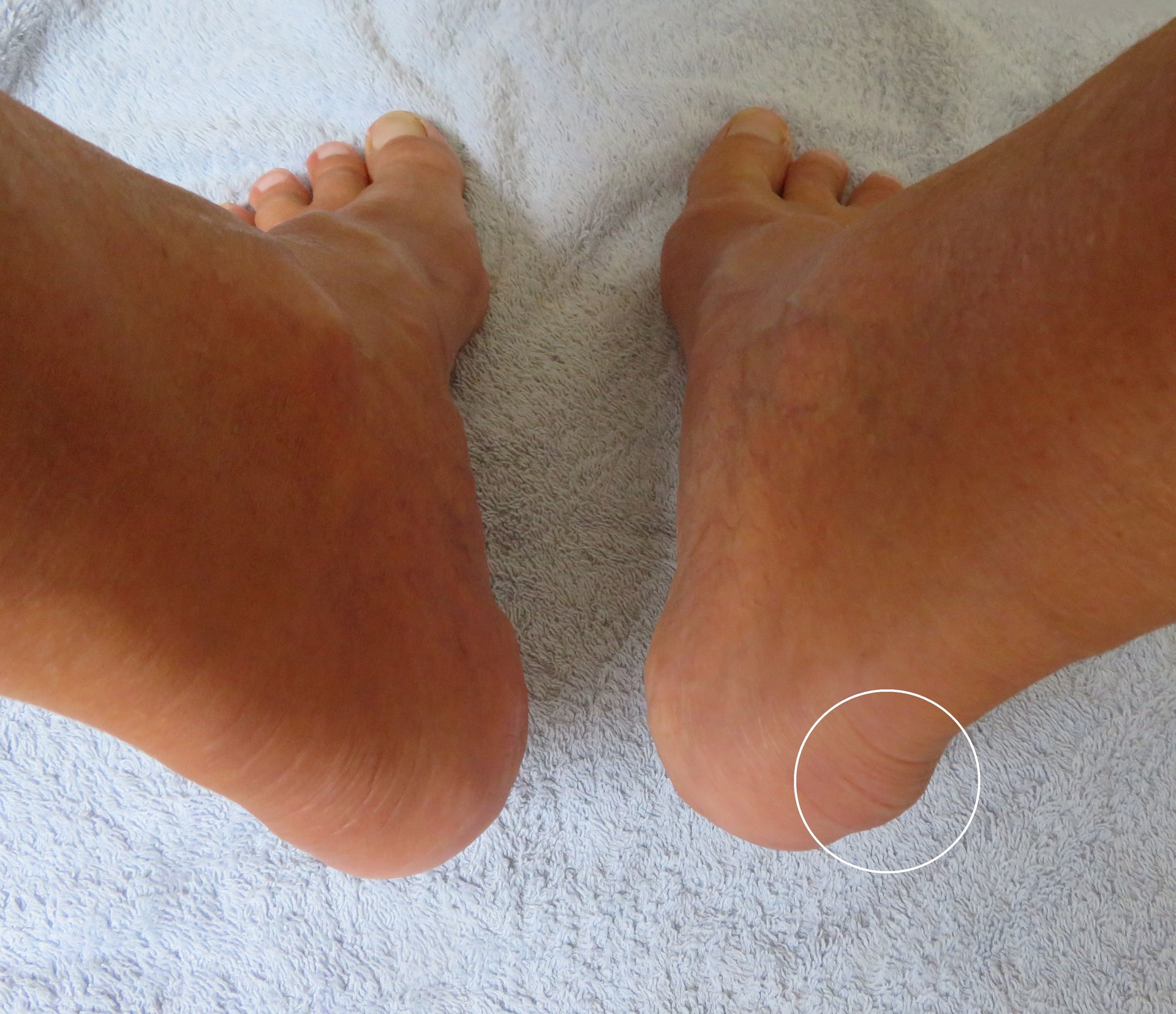 Posterior clinical photograph of both heels with the right posterosuperior calcaneal prominence circled, compared with a normal left heel.