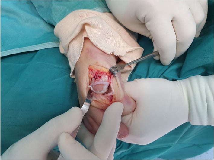 Operative view showing more than half of the first metatarsal head cartilage destroyed