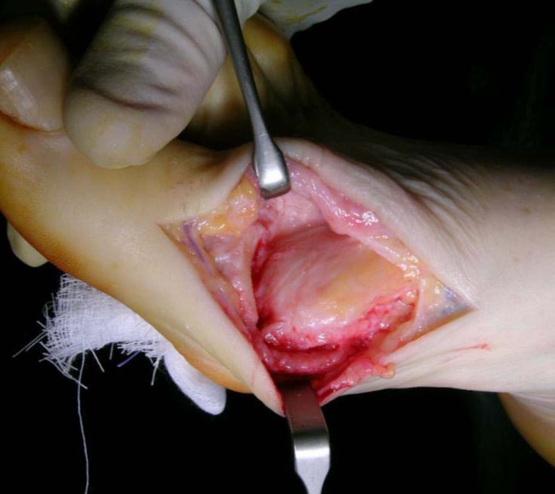 Operative view showing a capsular flap covering the first metatarsal head