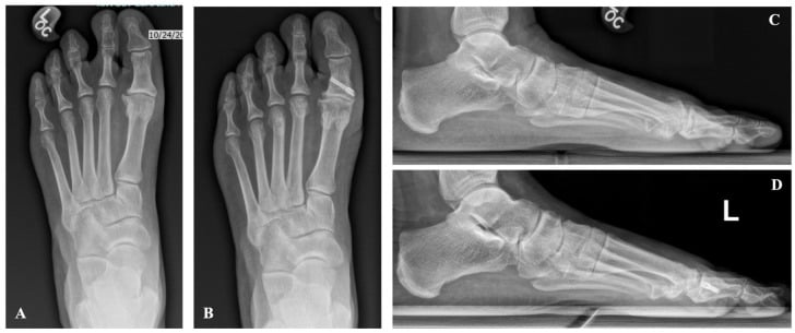 AP (A, B) and lateral (C, D) radiographs before and six months after cheilectomy and Moberg osteotomy