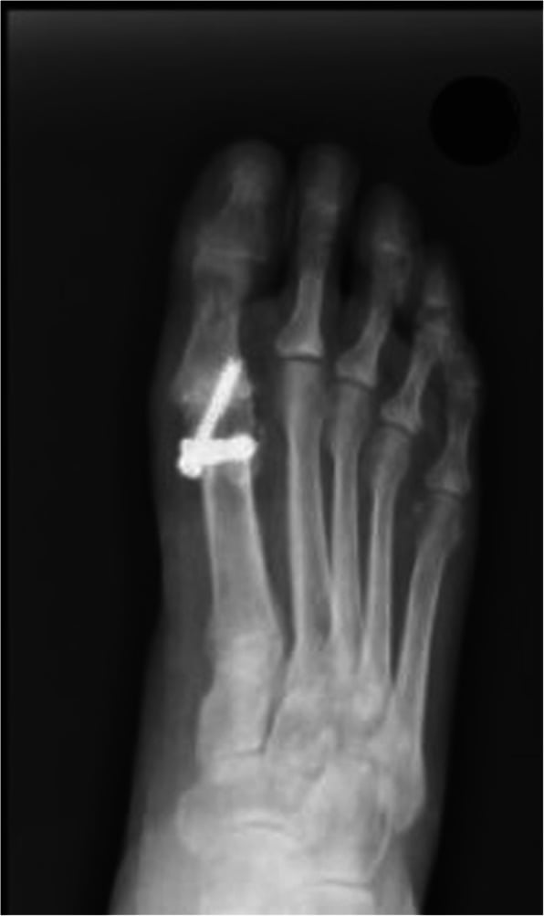 Foot radiograph showing prominent hardware after first MTP arthrodesis