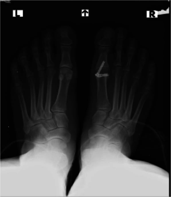Radiograph of both feet showing nonunion of a first MTP arthrodesis on one side