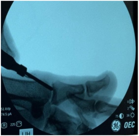 Intraoperative lateral fluoroscopic image with a burr at the dorsal first metatarsal head