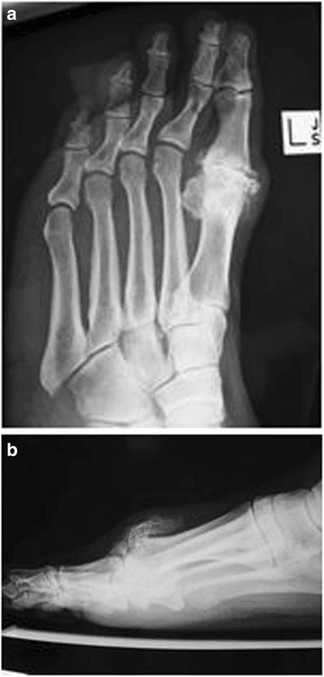 Two-panel foot radiograph of hallux rigidus showing first MTP joint-space narrowing, osteophytes and a dorsal prominence.