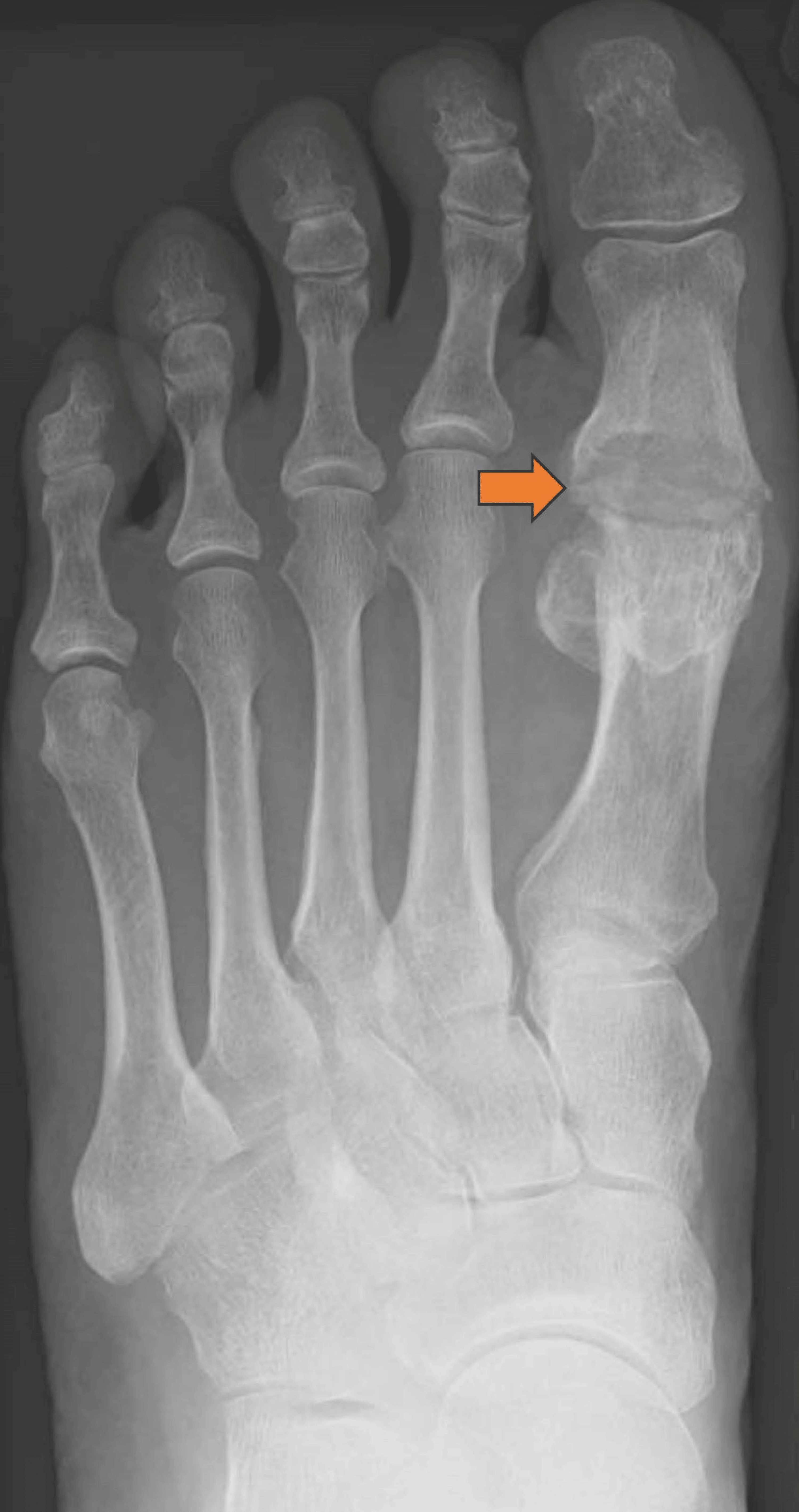 Dorsoplantar foot radiograph after a double-stemmed silastic first MTP joint replacement, with an arrow marking the implant at the joint.