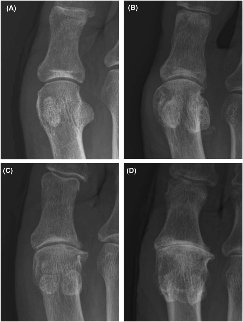 Four close-up radiographs of the first MTP joint, panels A to D, showing Hattrup-Johnson grades 0 to 3 of hallux rigidus