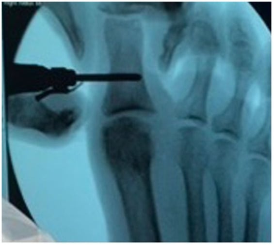 Fluoroscopic image with a burr passed across the hallux proximal phalanx during a percutaneous Moberg osteotomy