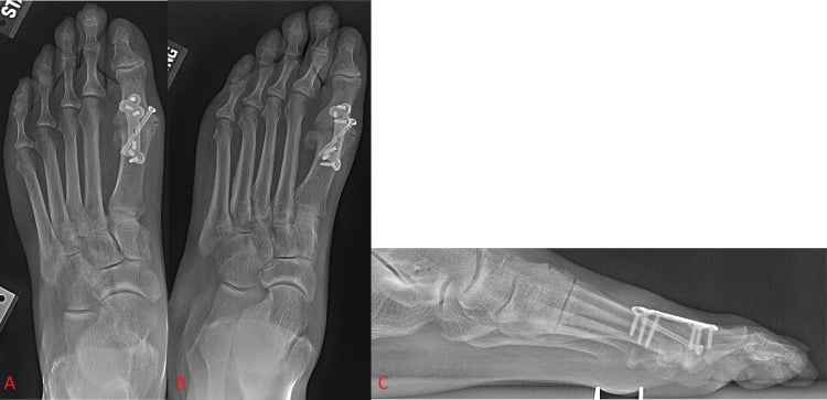 AP (A), oblique (B) and lateral (C) radiographs showing first MTP arthrodesis with a dorsal plate and lag screw