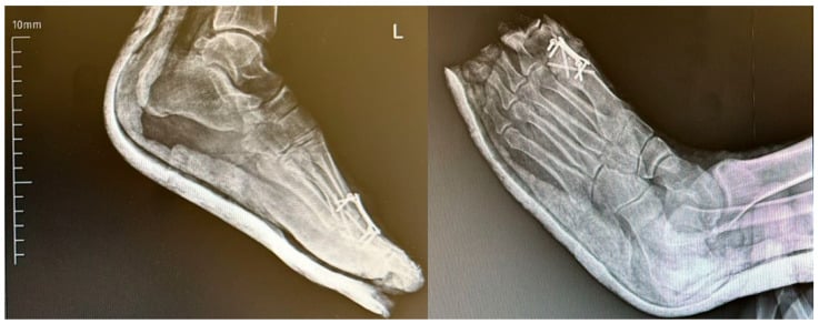 Two radiographs of a first MTP arthrodesis fixed with crossing screws, the foot resting on a flat plantigrade support