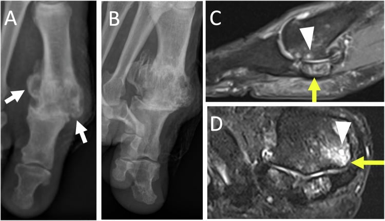 Radiographs (A, B) and MRI (C, D) of severe first MTP osteoarthritis, with arrows and arrowheads marking the findings