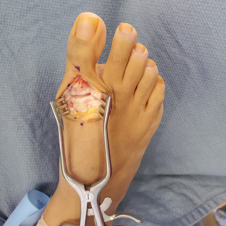 Dorsal exposure of the first MTP joint held open with a self-retaining retractor