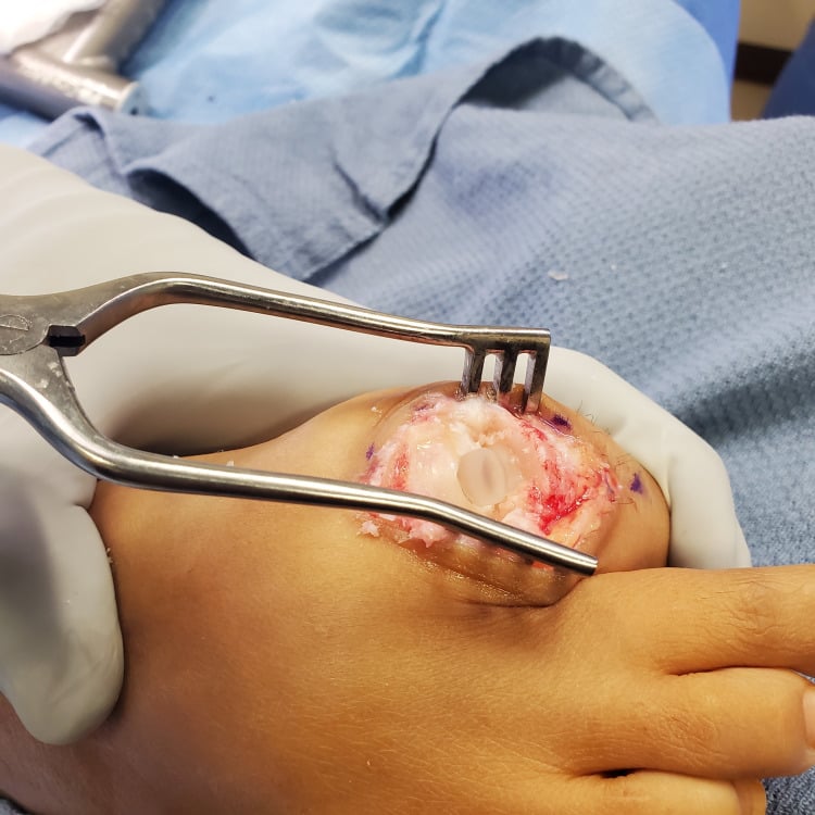 Operative view of a translucent synthetic cartilage implant seated in the metatarsal head