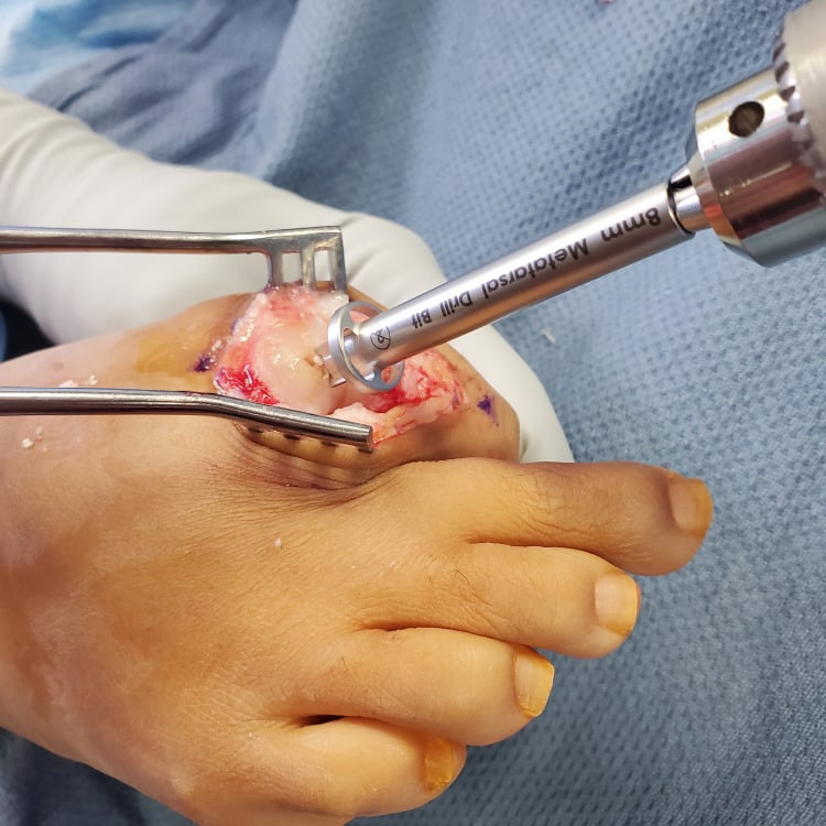 Metatarsal head being prepared with an instrument labelled 8mm Metatarsal Drill Bit