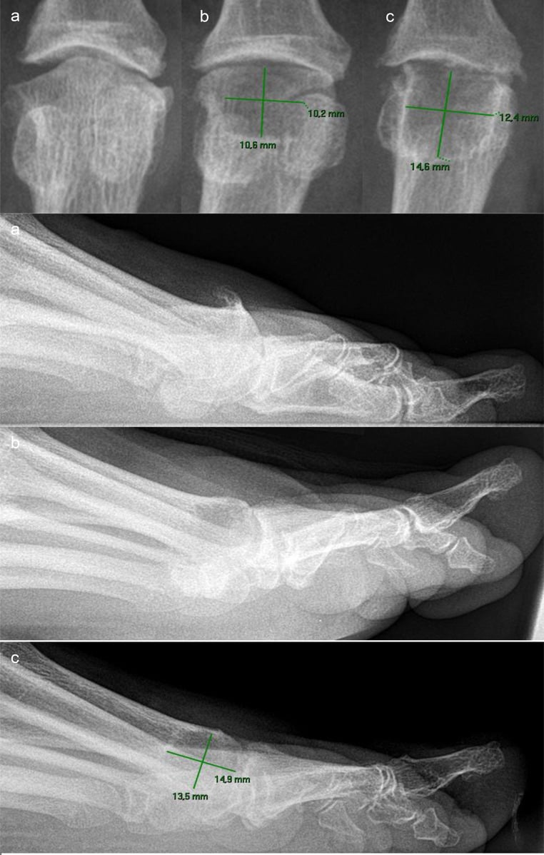 Serial radiographs, panels a to c in two projections, showing progressive enlargement of the cavity around a synthetic cartilage implant, with measurements