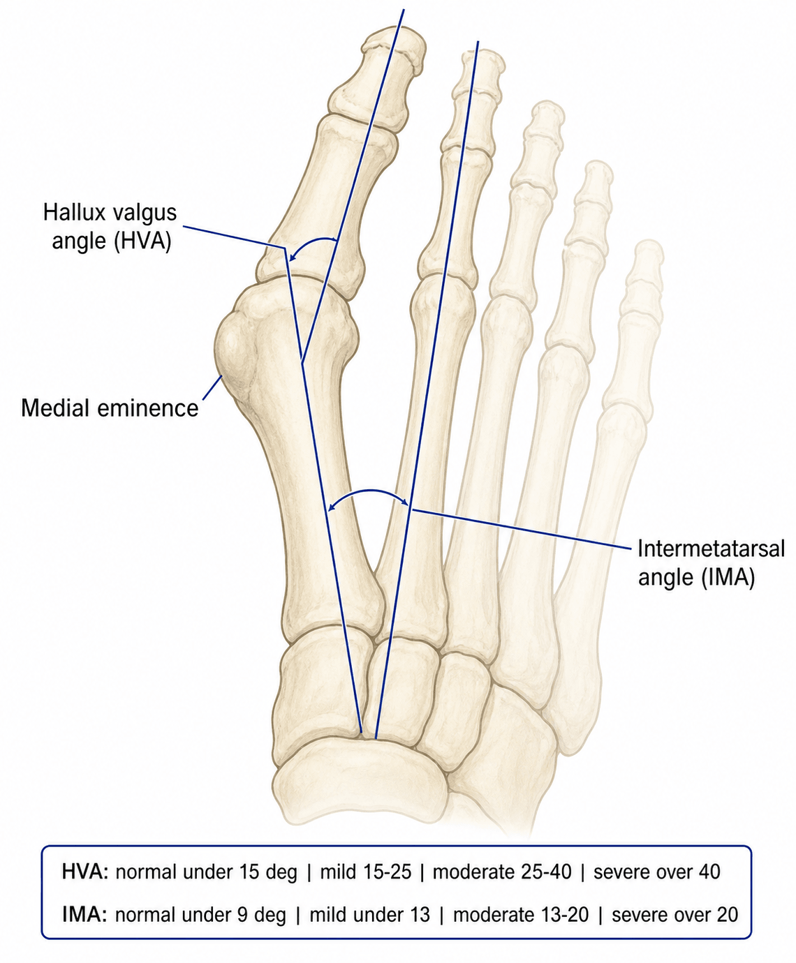 Diagram of how the hallux valgus angle and intermetatarsal angle are measured, with severity thresholds.