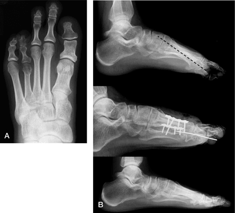 5-panel X-ray series showing Endolog technique for hallux valgus correction